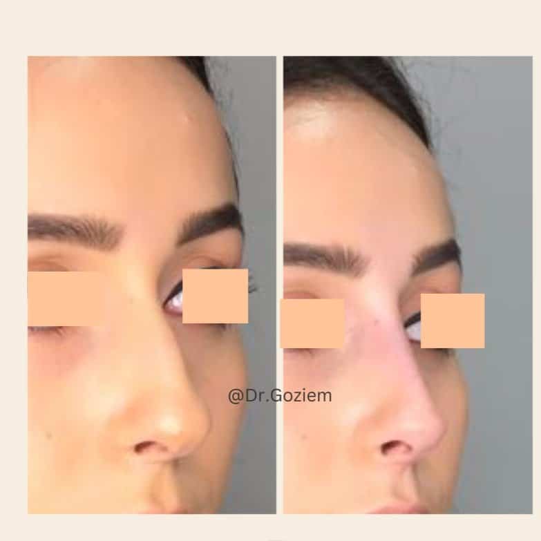 non-surgical nose treatment image