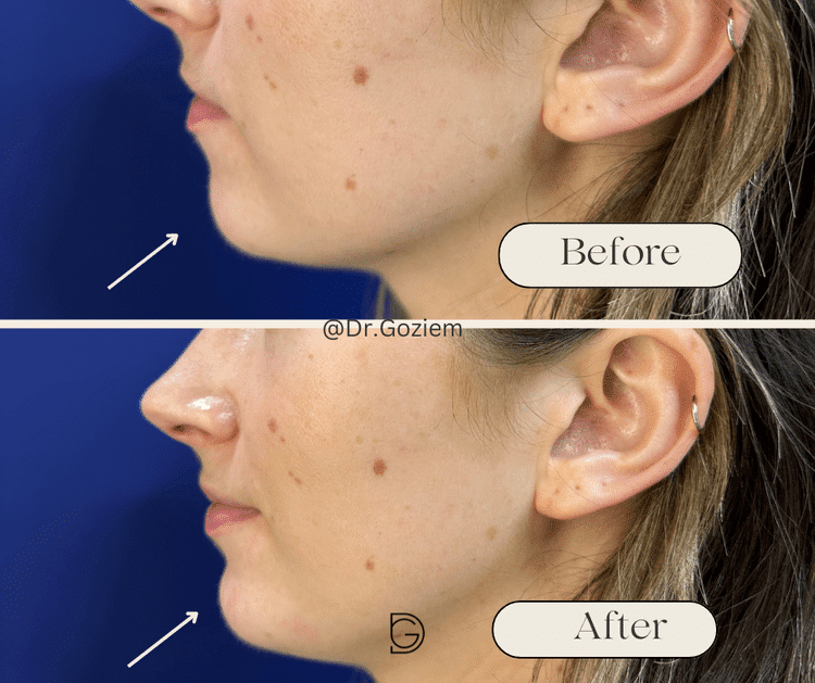 Before+and+after+profile+balancing+ Chin / Jawline Filler