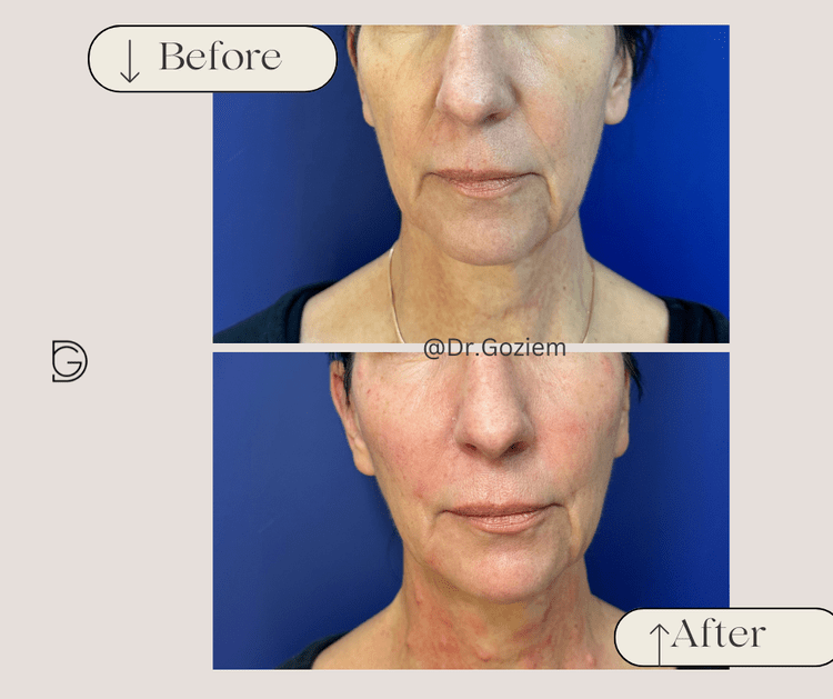 profile+balancing,+facial+rejuvenation+before+and+after