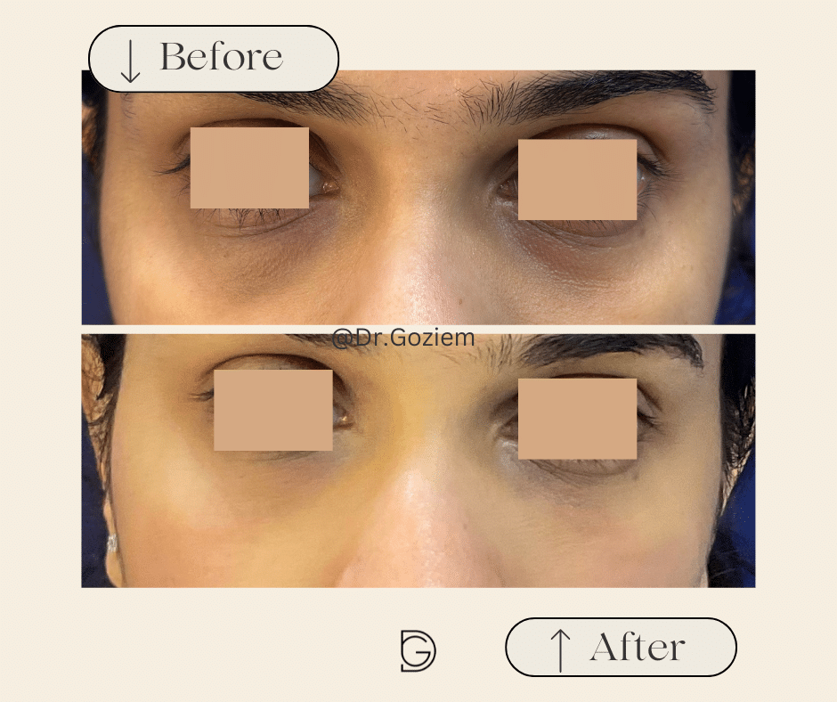 Under Eye / Tear Trough 1