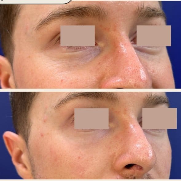 Tear Trough Treatment 2 Tear Trough+dark circles