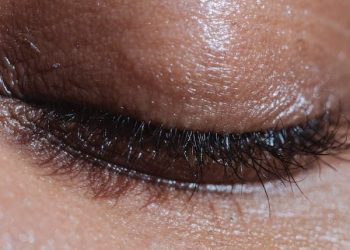 lack of sleep+thinning skin+Pigmentation+natural remedies, and professional treatments