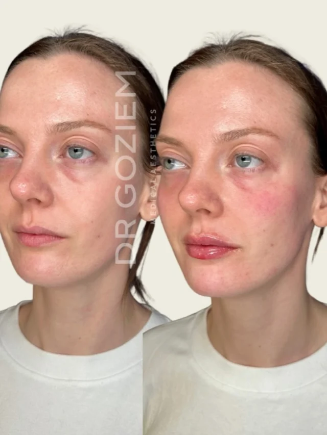 A beautifully subtle transformation for Miss N
By enhancing her lips, cheeks, chin, and tear troughs with dermal filler, we’ve restored volume, improved facial balance, and refreshed her overall look while keeping her results natural.Book your consultation today and let’s create a treatment plan tailored to you.#DermalFiller #FacialBalancing #CentralLondonAesthetics #NaturalResults